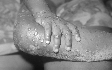 Monkeypox Jadi Kedaruratan Kesehatan Global, Distan Mataram Perketat Lalu Lintas Hewan