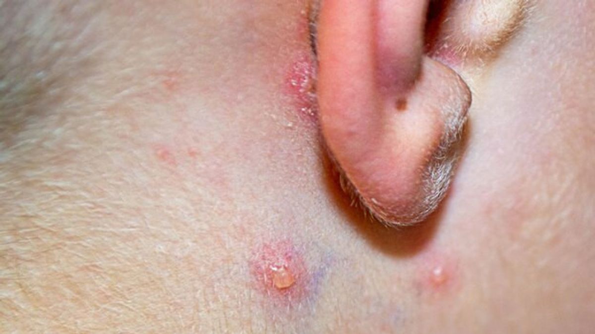 Acne Grows Behind Ears, Knows Causes And How To Treat It