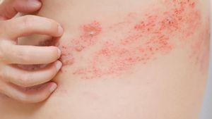 Perempuan 19 Persen Lebih Rentan Terkena Cacar Api, Kenapa?