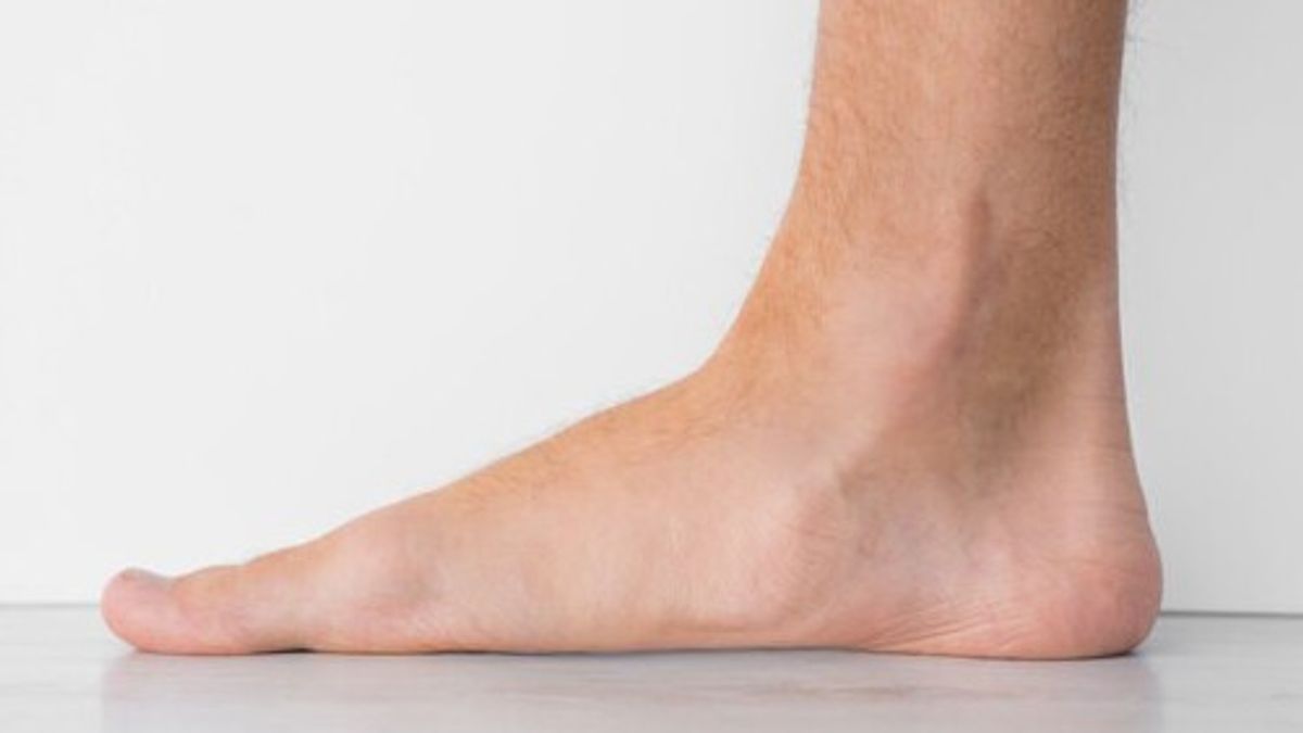 Flat Foot, Get To Know The Effects And Causes