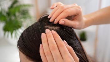 Knowing The Difference Between Ketombe And Dry Head Skin, Do You Know How To Overcome It?