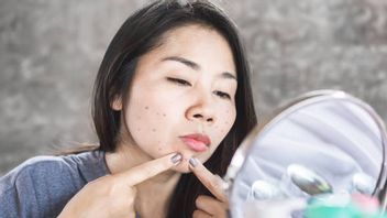 Not Congested But Still Swelling? Explanation Of Acne Experts About The Emergence Of Black Flek