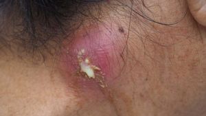 Berapa Lama Luka Bernanah Sembuh? Simak Cara Penyembuhannya di Sini