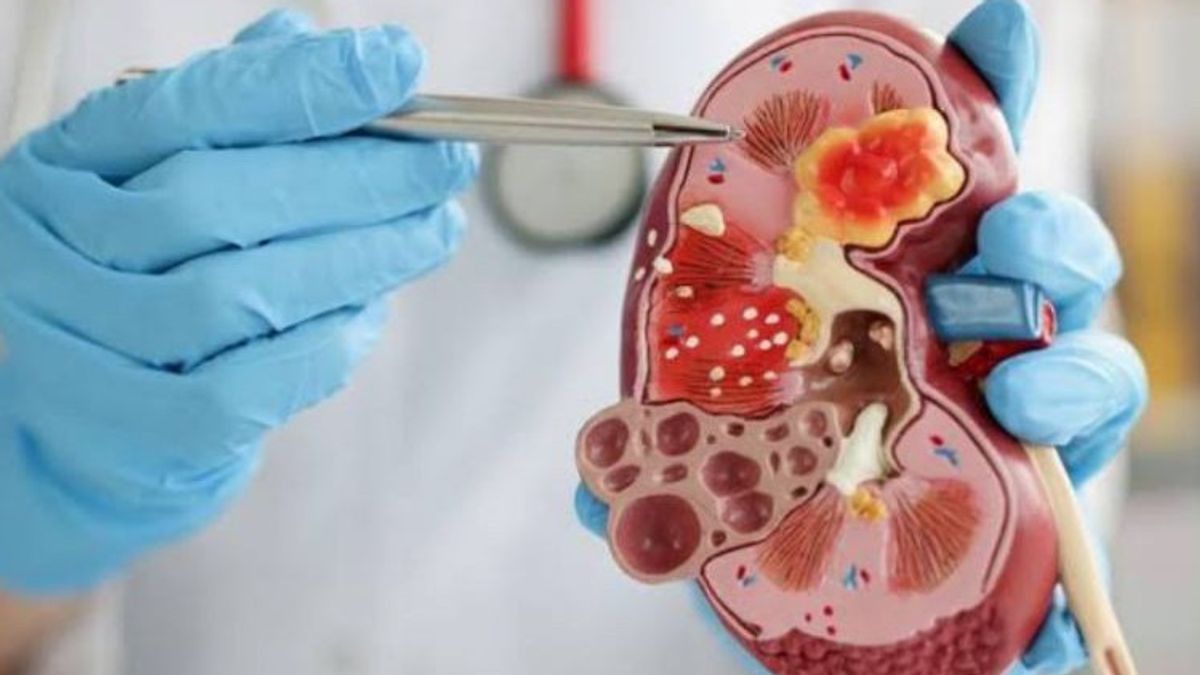 Makanan yang Harus Dihindari Penderita Batu Ginjal, Catat Ini