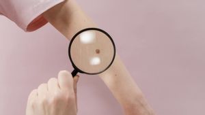 Jangan Diremehkan, Ini Tanda Kanker Kulit yang Patut Diwaspadai