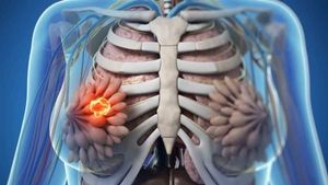 Kanker yang Banyak Diderita Wanita, Ini Jenis-jenisnya