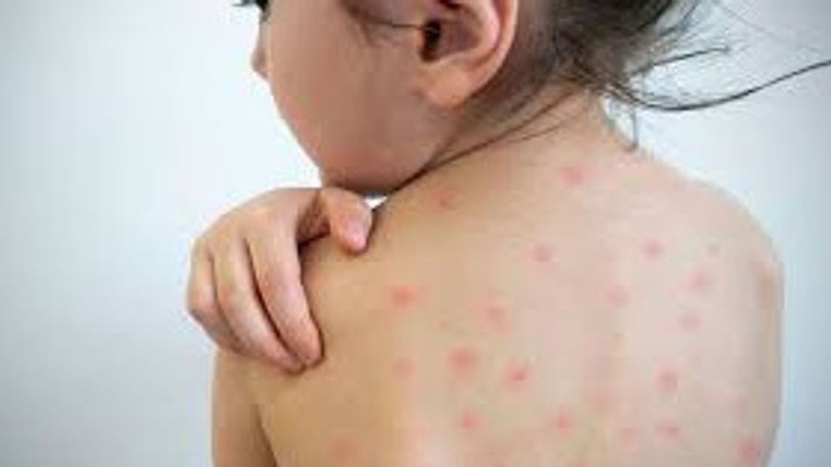 麻疹患者はどんな気持ち？症状と原因を知る