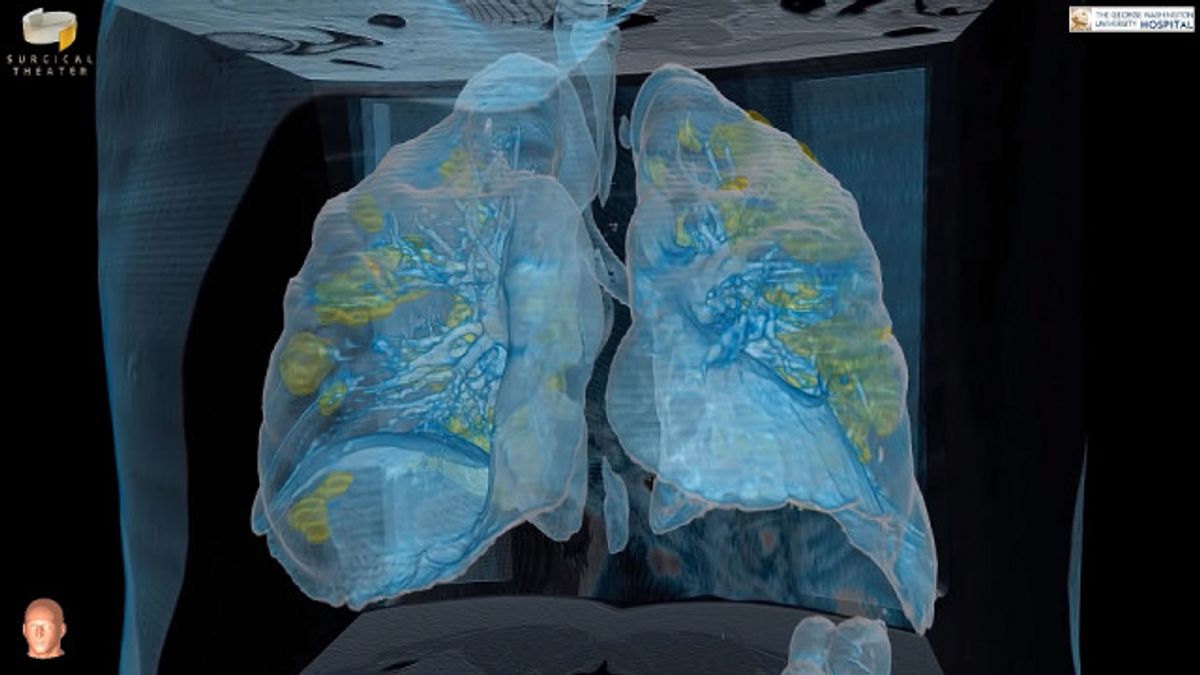 COVID-19患者の肺状態の仮想的な投影