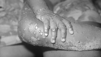 IDI Reminds Doctors In Indonesia About Monkeypox Has The Potential To Become A World Epidemic