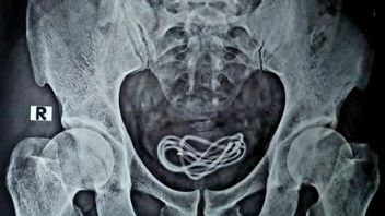 有一个奇怪的恋物癖，医生被迫从印度男性膀胱中取出充电器电缆