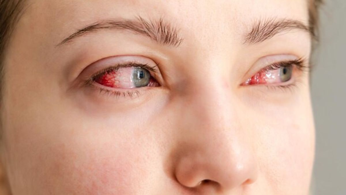 Without Drugs, Red Eyes Can Be Overcome In The Following 8 Ways