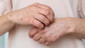 How to Prevent Chicken Pox? Find Out the Causes and Symptoms Here