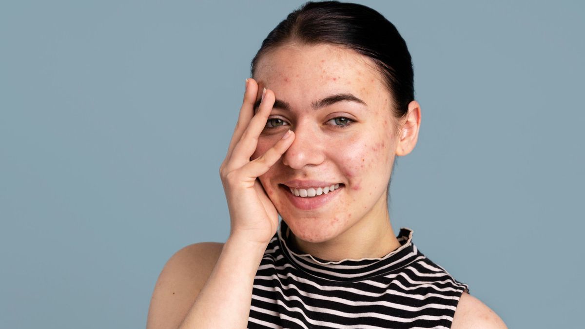 Mandatory Changing Habits, Here Are 8 Reasons Acne Still Grows Even Though Routine Treatment