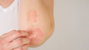 Tips Menggunakan Riasan Wajah Saat Psoriasis Sedang Kambuh