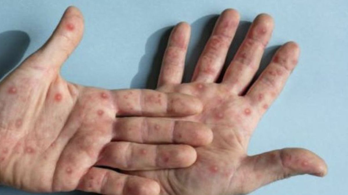 Ministry Of Health: Monkeypox In Indonesia 38 Cases, Latest From Cirebon