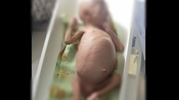 اضطرابات السائل الصفراوي ، طفل يبلغ من العمر 2 سنة في كاراوانغ يعاني من سوء التغذية