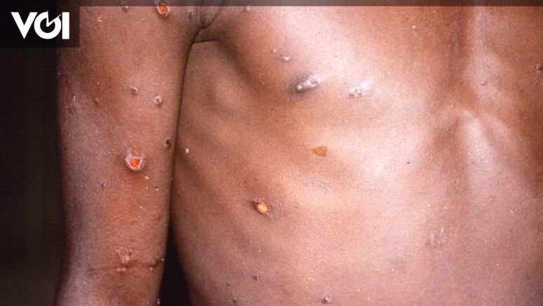 Mysterious Hepatitis Has Not Been Done, Now US Confirmed Monkeypox Appears