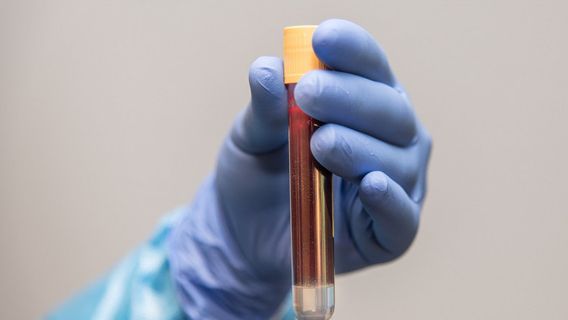 Ingin Jadi pendonor Plasma Konvalesen? Ini Syaratnya