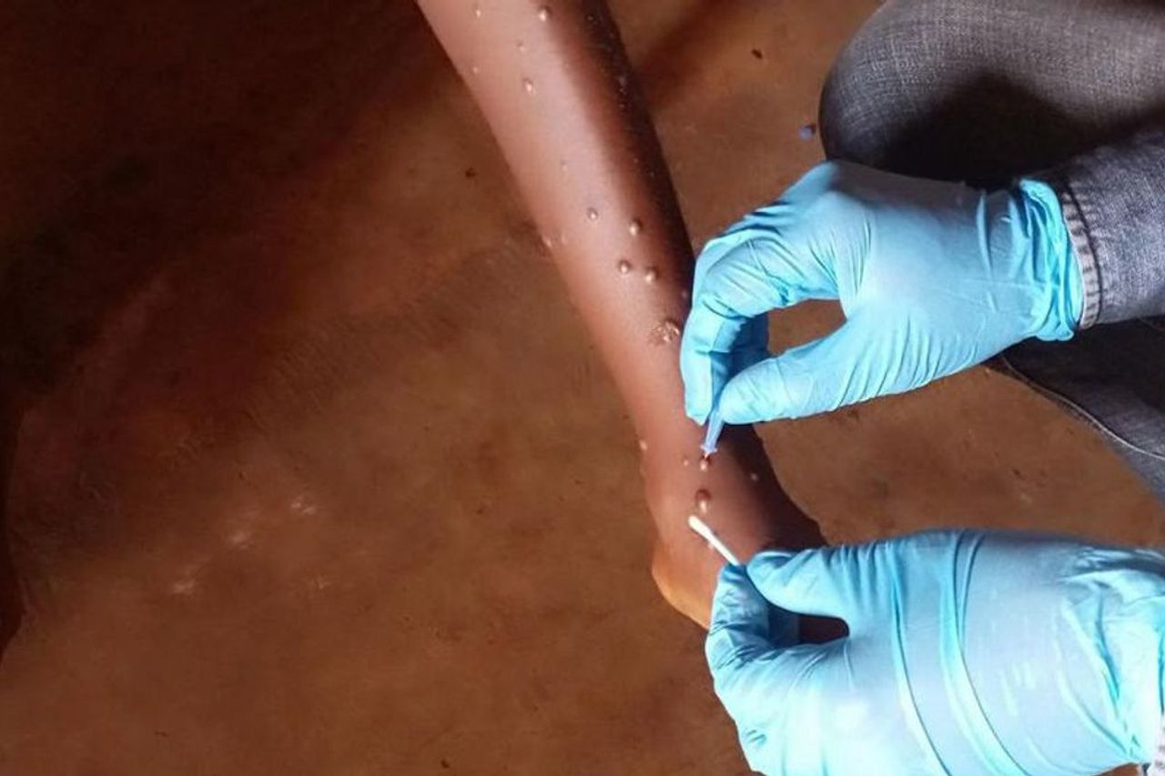 Une nouvelle variante du waqx augmentée en Ouganda pourrait se propager de peau à peau