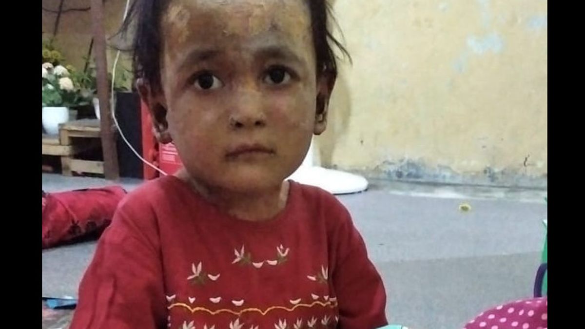  在棉兰再次发现罕见的皮肤病儿童， 类似于海卡尔和扎基拉