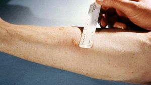 Waspada TBC! Ketahui Apa Itu Tes Mantoux sebagai Diagnosis Awal 