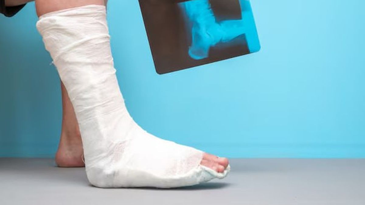 Cara Berjalan setelah Patah Tulang Kaki: Panduan Pemulihan hingga Bisa Melangkah Normal