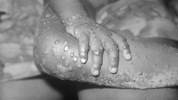 These Are 5 Categories Of People Exposed To Monkeypox, Be Careful It Can Be Transmitted Through Droplets And Body Fluids!