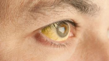 北カリマンタンは、黄色い皮膚と強膜の急性肝炎症状の症例を予測