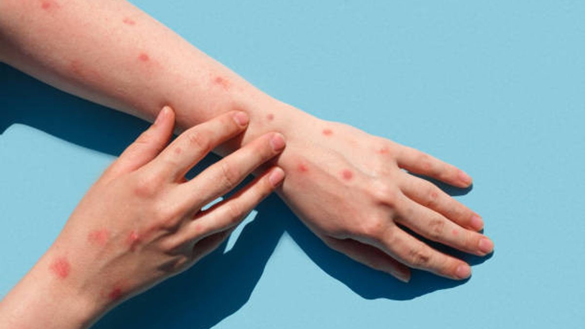 Joint Two Types Of Virus, New Mpox Strain Found In UK