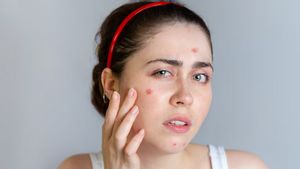Kiat Sederhana Mengatasi Jerawat Hormonal, Mulai dari Rutin Merawat Hingga Jaga Pola Makan