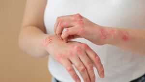 7 بنود غذائية للأشخاص الذين يعانون من Impetigo حتى لا تزداد سوءا