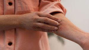 Kulit Gatal karena Dermatitis Atopik Sering Kambuh? Waspadai 7 Penyebab Ini