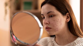 水痘の傷跡を消す最も効果的な方法