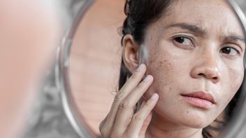 This Can't Be Allowed! Here's How To Get Rid Of The Black Acne In An Ampuh Pipi