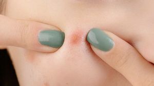 Berapa Jangka Waktu untuk Jerawat Hormon Menghilang? Ini Penjelasan Dokter