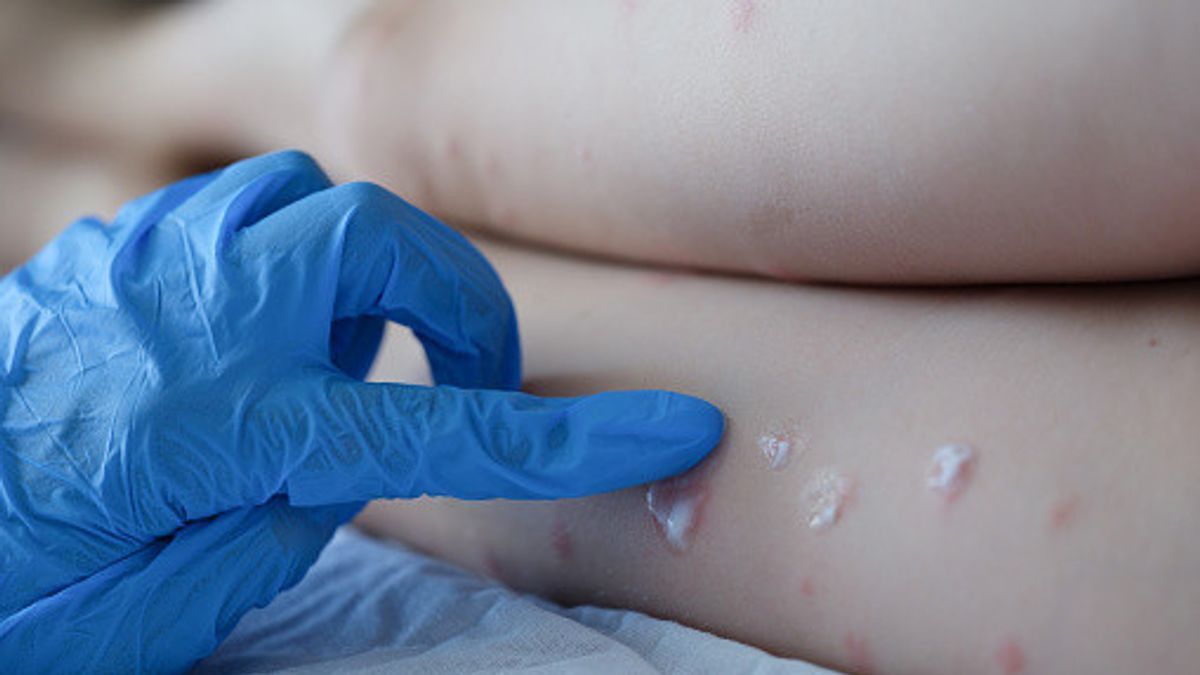 流行病学家提醒政府立即准备猴痘疫苗