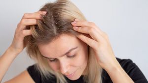 4 Cara Hilangkan Kutu Rambut dan Telurnya dengan Cepat