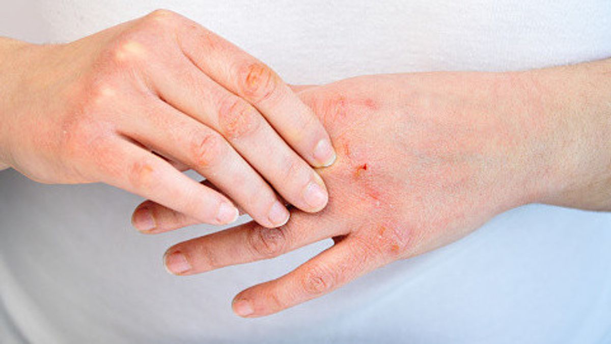 التهاب الجلد التماسي بسبب حساسية المنظفات ، والتعرف على الأعراض وكيفية علاجها