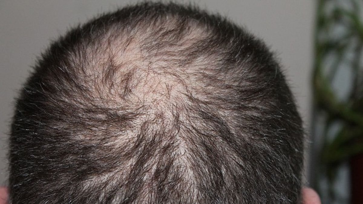 From Turkey To Indonesia, Hair Transplant Becomes A Trend To Overcome Hair Weighting