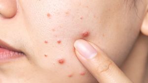 Obat Jerawat Haloskin: Solusi Perawatan Kulit Ampuh dari Halodoc