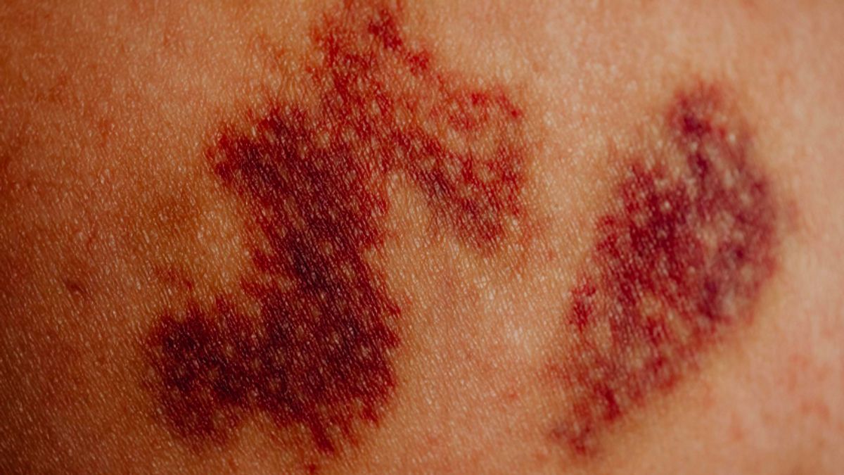 Entering The End Of The Year, Enterovirus Cases Increase In This Country