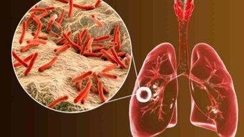Ministry Of Health Reveals 7 Early Detection Approaches For TB