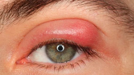 What Causes Bintian Eyes? Know How To Treat It Properly