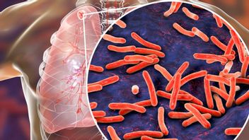 ارتفاع حالات السل في Banyuwangi، يطلب مجلس النواب من الحكومة تعزيز الكشف المبكر