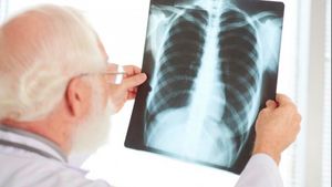 Kanker Paru Bisa Menyerang Non Perokok, Kenali Penyebab dan Gejalanya Sejak Dini