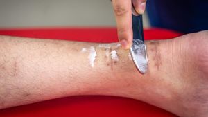 Jangan Panik, Begini Cara Menyembuhkan Luka Bernanah dengan Cepat dan Aman 