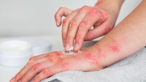 5 Cara Mengobati Jamur Kulit yang Membandel, dari Bahan Alami hingga Obat Topikal