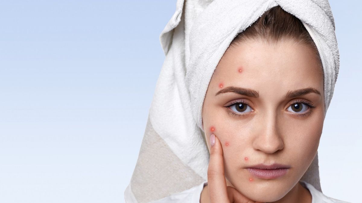 Don't You Know The Difference Between Hormone Acne And Bacteria? Check The Full Explanation