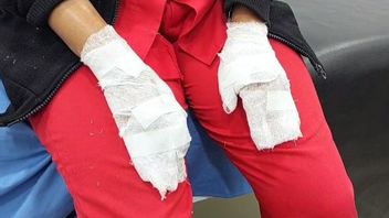 This Is What Pertamina Gas Station Employee's Hand Looks Like, Which Caught Fire Due To The Pertalite Pump Explosion