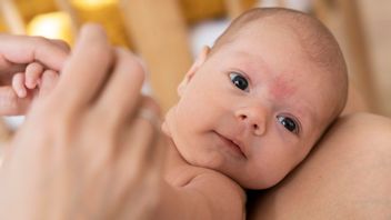 Knowing The Causes Of Acne And Red Spots In Babies, Here's How To Treat It